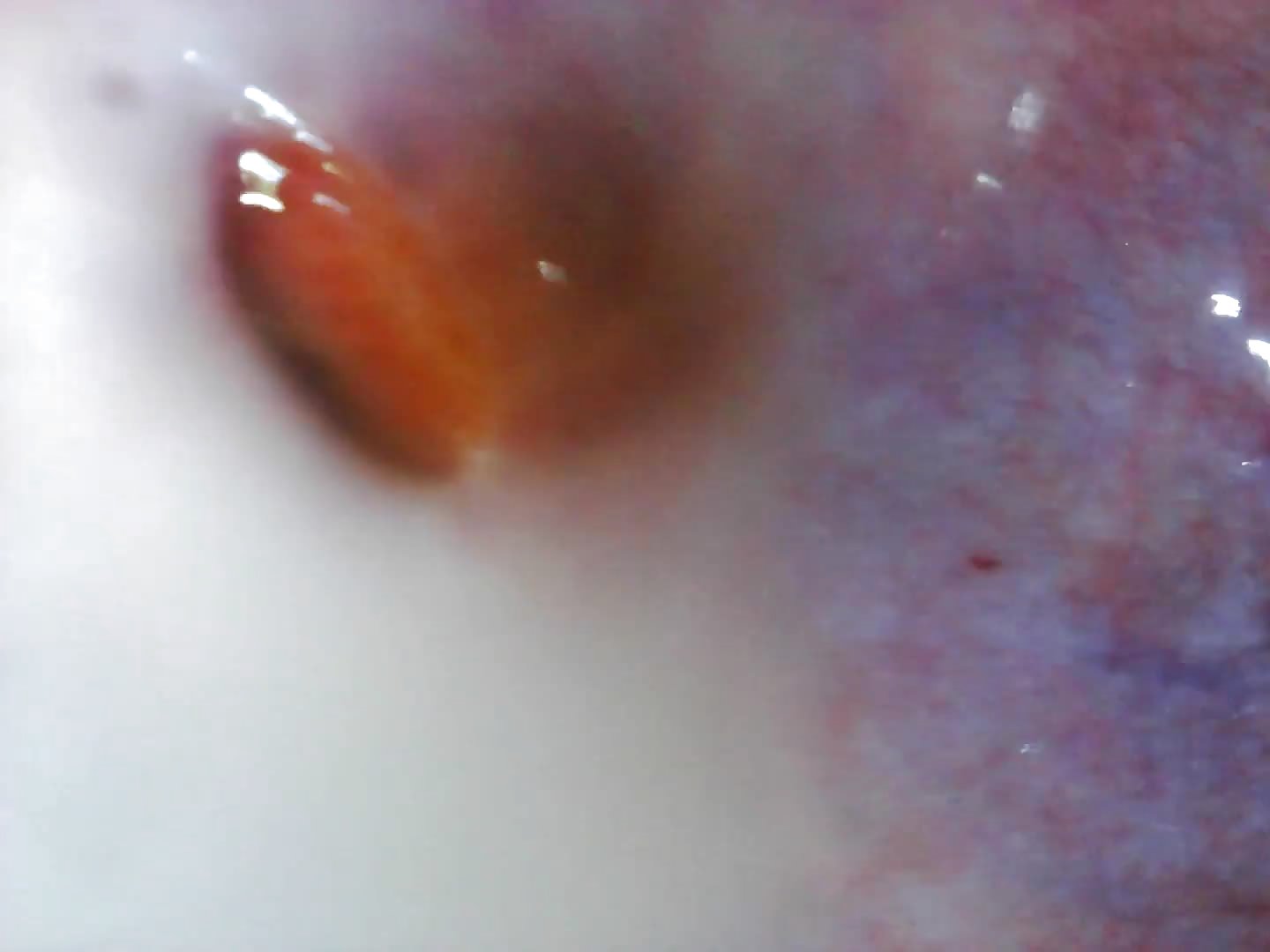Endoscope Fill up